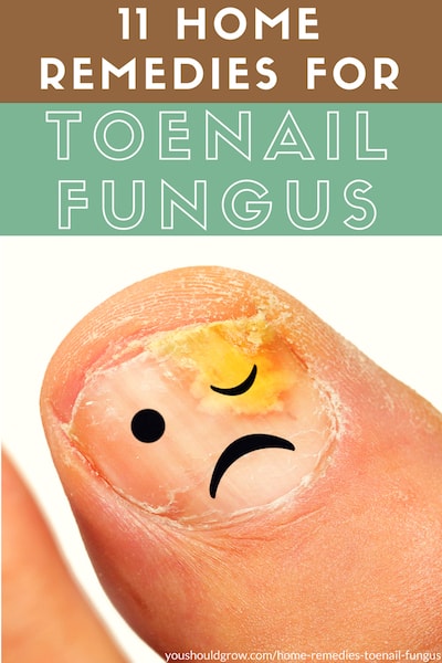 11 home remedies for toenail fungus. Text with image of infected toenail and frowny face